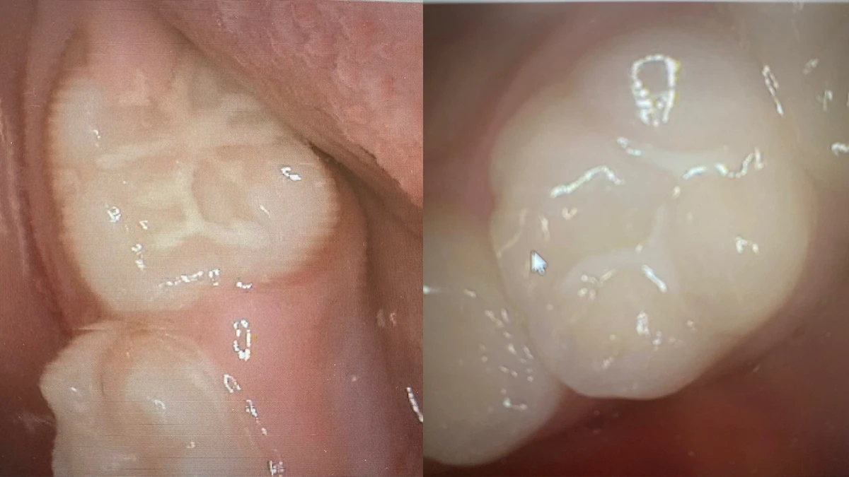 Image for Preventive Filling - Dental Sealant