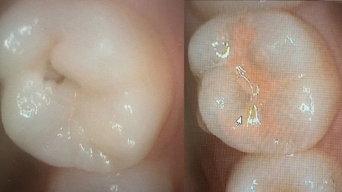 Image for Preventive Filling with Glass Ionomer